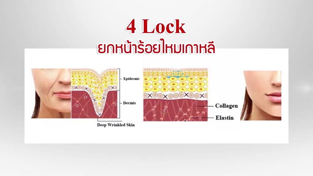 ุคุ้มมาก-barcony-โปรแกรมร้อยไหมเกาหลี-ยกหน้า-ยกคอ-ยกกระชับ-เส้นไหม-80-เส้น