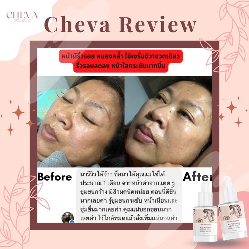 cheva-booster-serum-แบบแพ็คคู่สุดคุ้ม-เซรั่มหน้าใส-ป้องกันการเกิดสิว-ลดรอยสิว-กู้ผิวเด็ก-ด้วยสารสกัดจากธรรมชาติ-100