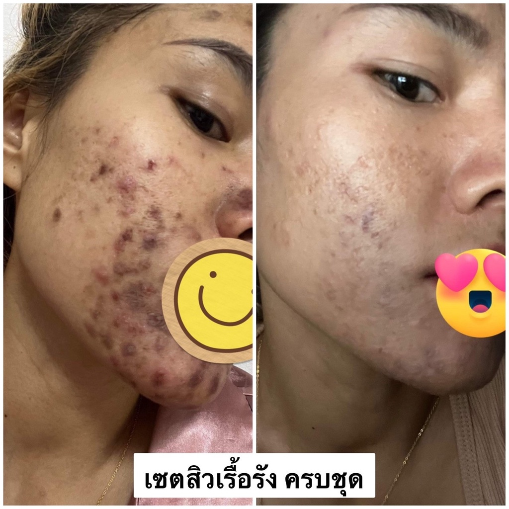 hya-aha-serum-ไฮยา-เซรั่ม-ผลัดเซลล์ผิว-ลดรอยแผลเป็น-ลดริ้วรอย-preenhouse