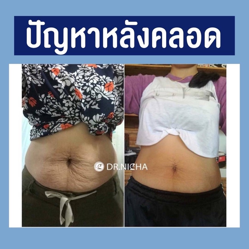 ส่งฟรี-ชุดเริ่มต้น-เจลเย็นดร-ณิชา-และ-คอร์เซ็ตรัดเอว-ดร-ณิชา-ส่งฟรี-ไม่ต้องใส่โค้ดส่วนลดค่ะ