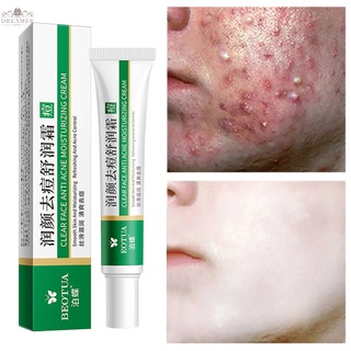 【DREAMER】Effective acne cream, treatment to lighten acne spots, oil control, shrink pores, whiten 20g