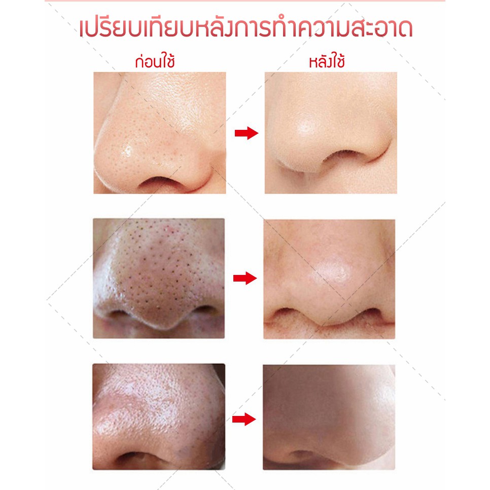 ที่ดูดสิว-สิวเสี้ยน-สิวข้างจมูก-ดูดสิวอุดตัน-ลดจุดด่างดำบนใบหน้า-เครื่องดูดสิว