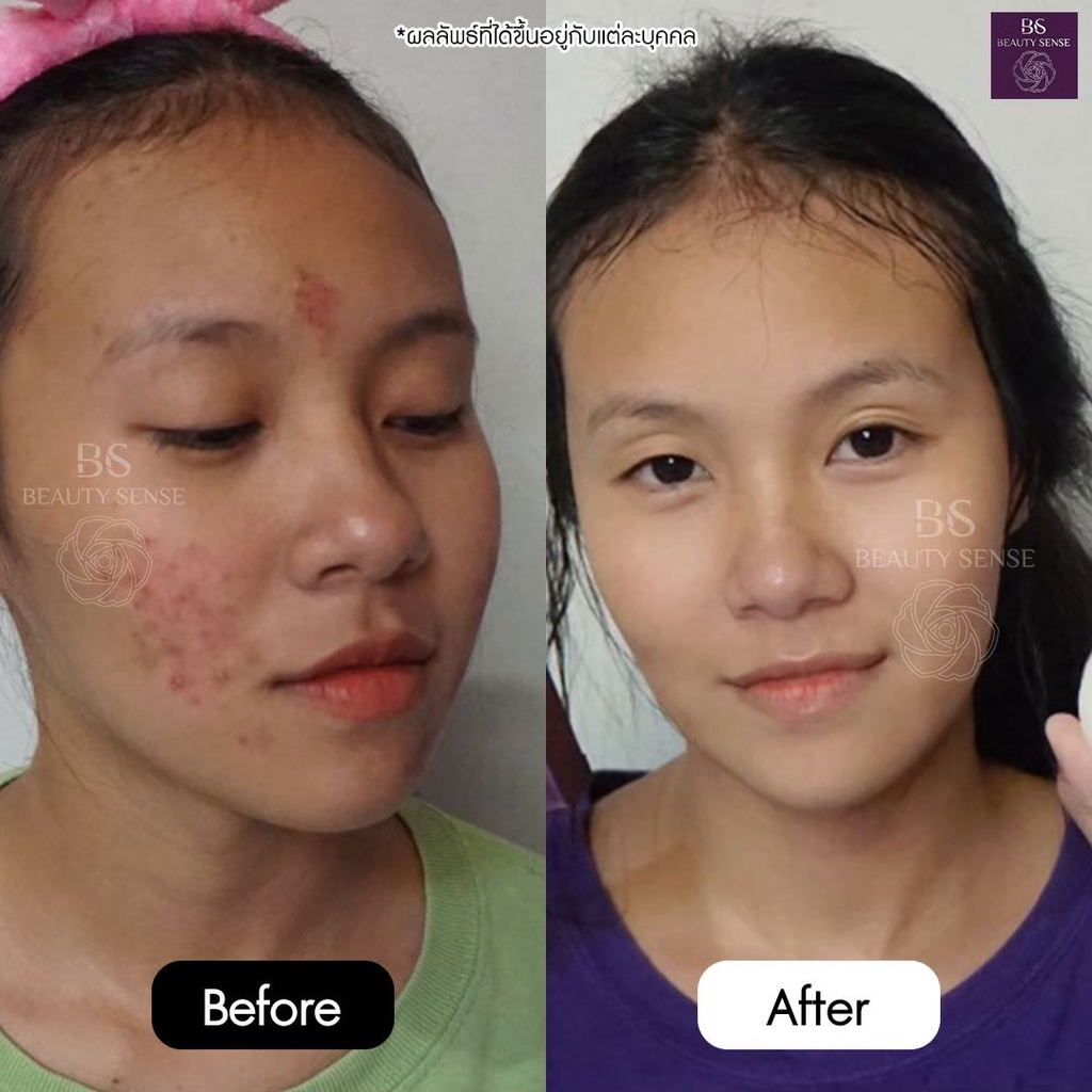 beauty-sense-soap-สบู่บิวตี้เซ้นส์-สบู่ขาวละมุน-ปลอดภัย-ไร้สารสเตียรอยด์-ลดสิวหนอง-สิวอักเสบ-สบู่ลดสิว-ผิวติดสาร