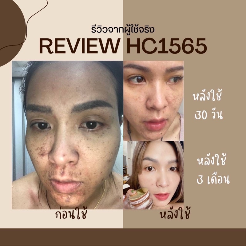 h-amp-c1565-sleeping-mask-amp-double-serum-รักษาสิวฝ้า