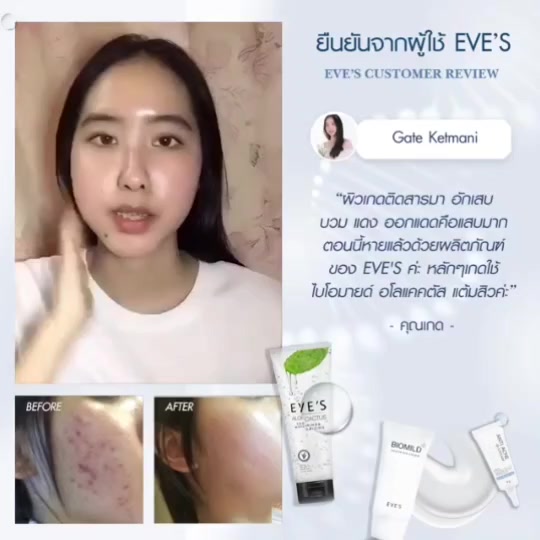 eves-อีฟส์-เซต-รักษาสิว-ผิวแพ้ง่าย-อโลแคคตัส-ไบโอมายด์-ครีมแต้มสิว-ผื่น-แพ้ง่าย-สิวอักเสบ-อุดตัน-ผิวติดสาร-ผิวมัน-แห้ง