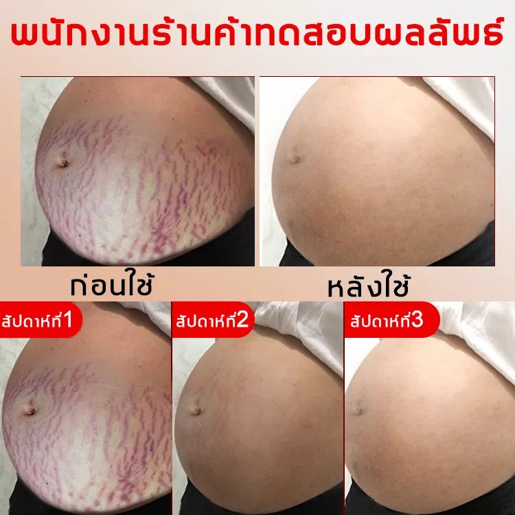 guanjing80g-ยาทารอยแตกลาย-ครีมทาลดรอยแตก-ครีมลดรอยแตกลาย-ครีมแก้แตกลาย-ครีมแก้ท้องลาย-ครีมทาแตกลาย-ครีมกันแตกลาย