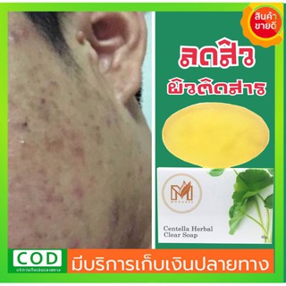 #สิว เห็นผล‼️ลดสิว สิวยุบ  ‼️สบู่ล้างหน้า #Silver​Nano​ ขจัดสิว​ เคลียร์​ผิวติดสาร​ #ลดสิว #ลดรอยสิว #ลดความมันใบหน้า