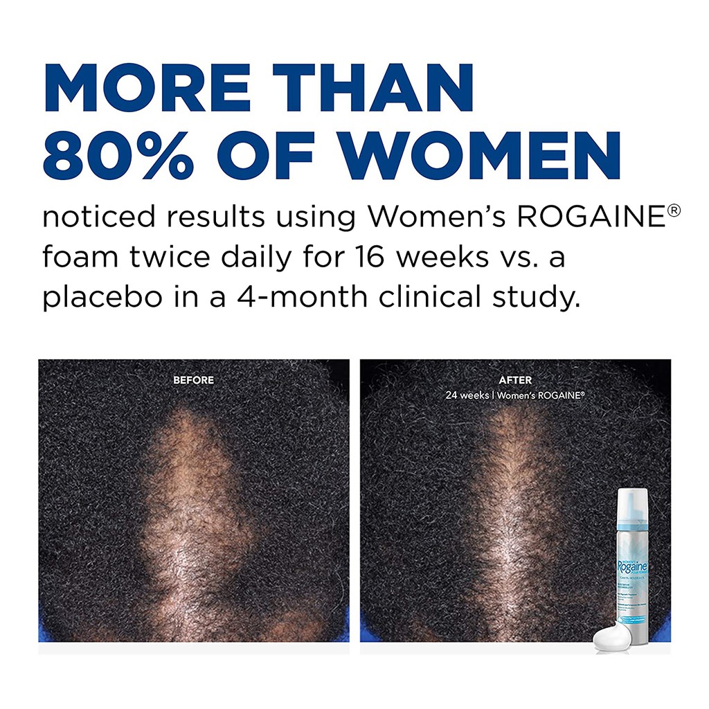 womens-rogaine-foam-1-ขวด-ใช้ได้-2-เดือน-ของแท้-ราคาถูกที่สุด