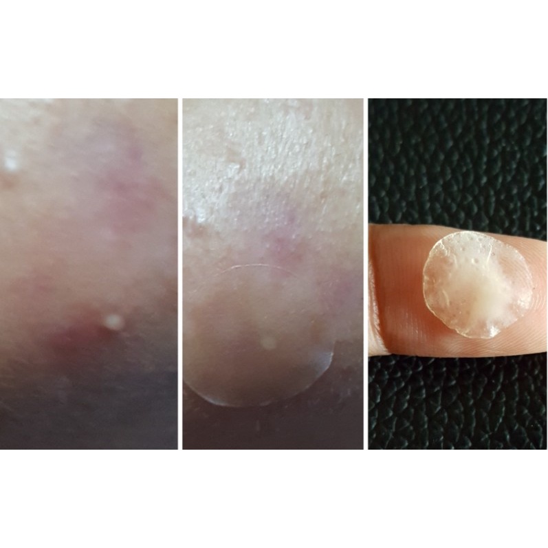 memuzsr-ลดเพิ่มทันที-45-dermaangel-แผ่นแปะสิวเดอร์มาแองเจิล-combo-set-36-ชิ้น-1กล่อง-d12n24