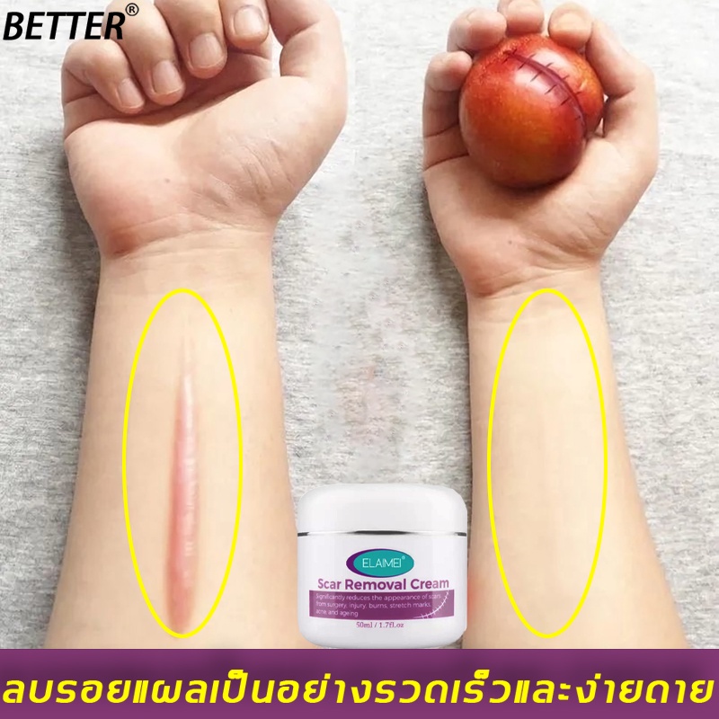 better-ครีมลดรอยแผลเป็น-ครีมลบรอยแผลเป็น-50ml-ทารอยแผลเป็น-ครีมลบแผลเป็น-ครีมทาแผลเป็น-รักษารอยแผลเป็น-ครีมลดรอยสิว