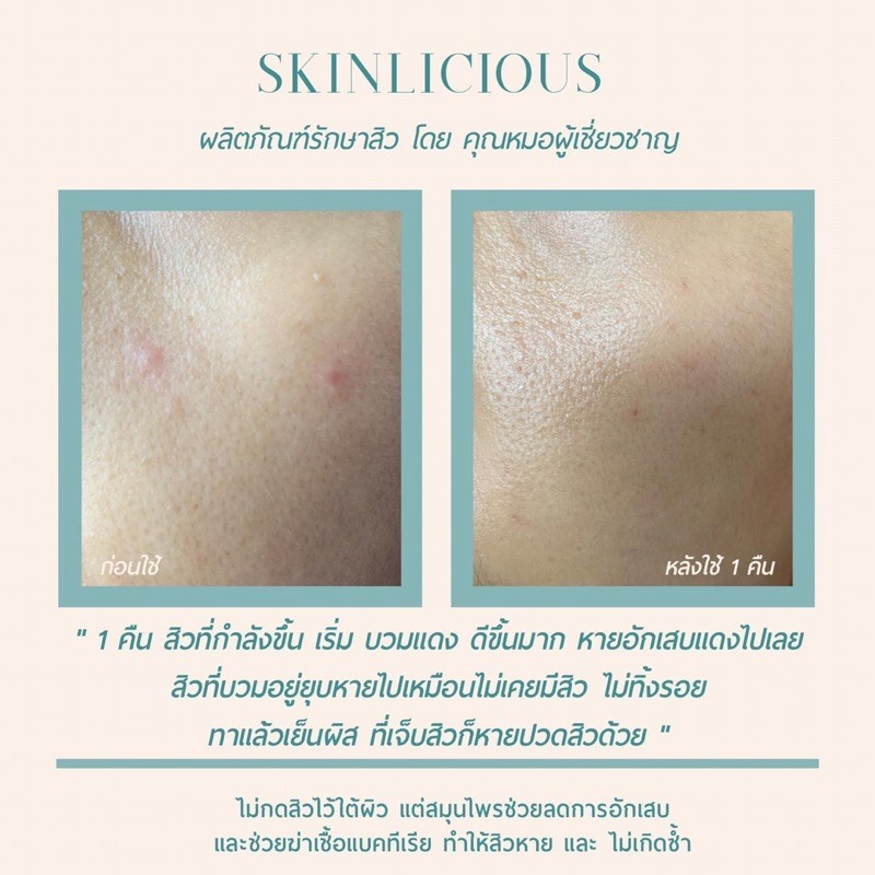 ที่แต้มสิว-skinlicious-หัวสิวแห้งไว-ลดการอักเสบ-ป้องกันการเกิดสิว