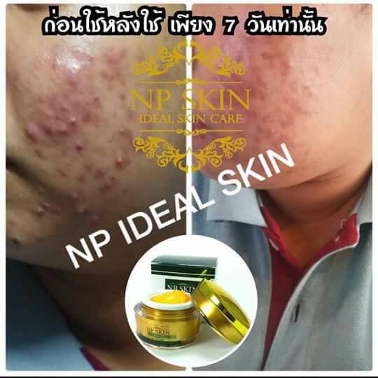 np-skin-ไนท์ครีม-รักษาสิว-ฝ้า-มีบริการ-cod-เก็บเงินปลายทาง-พร้อมส่ง