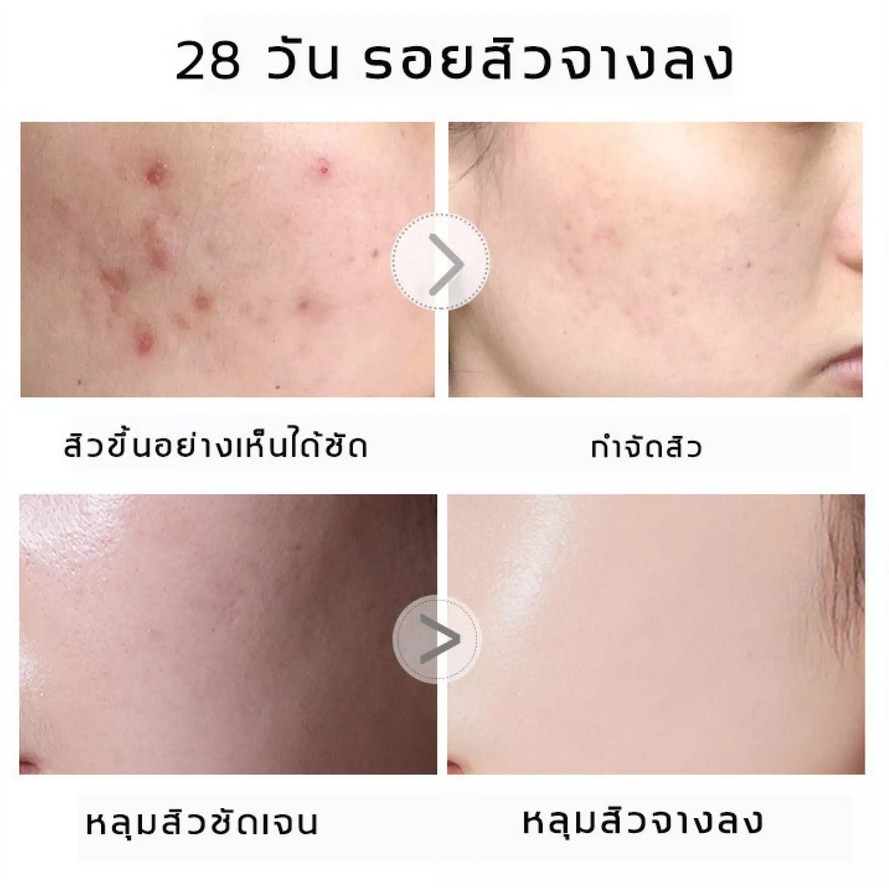 dr-ledun-ครีมลดสิว-20g-ครีมแก้ฝ้า-สิวหายถาวร-ครีมแต้มสิว-เจลรักษาสิว-เจลแต้มสิว-ครีมกำจัดสิว-ครีมบำรุงหน้า-ครีมหน้าขาวใส