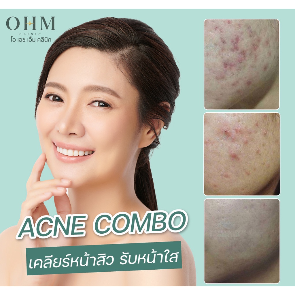 ภาพหน้าปกสินค้าAcne Combo เคลียร์หน้าสิว รับหน้าใส สิวหาย ผิวเนียนได้ โดยแพทย์ผู้เชี่ยวชาญ จากร้าน ohm_clinic บน Shopee