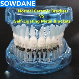 Dental Orthodontic Model with Ceramic and Self-Ligating Metal  Brackets for Patient Communication