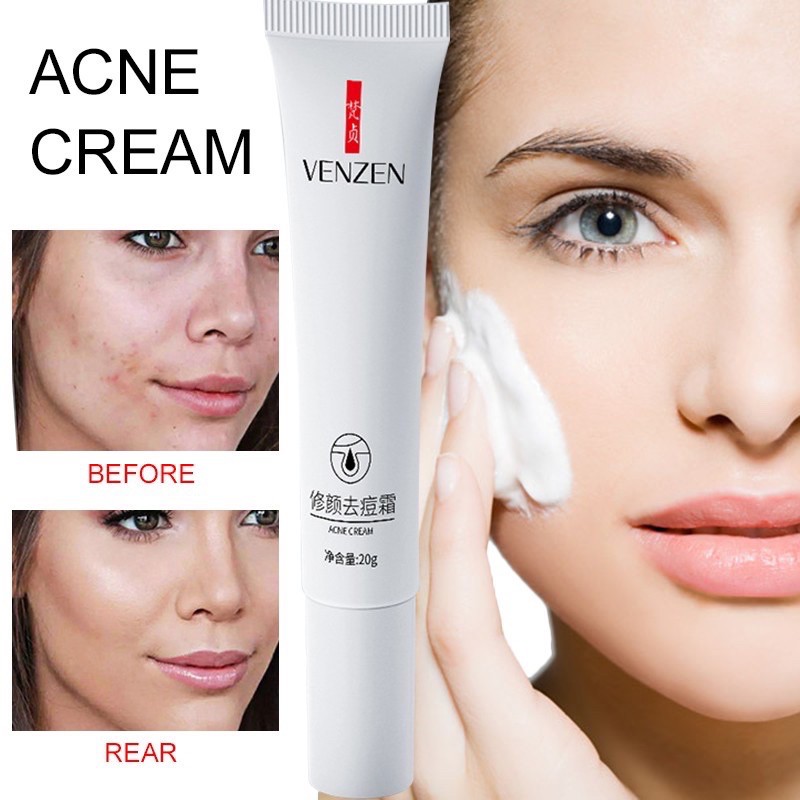 พร้อมส่งในไทย-venzen-acne-cream-ครีมรักษาสิว-รอยสิว-และช่วยซ่อมแซมผิวหน้าให้กระจ่างใส-20g-ฟรีของแถมเก็บเงินปลายทาง