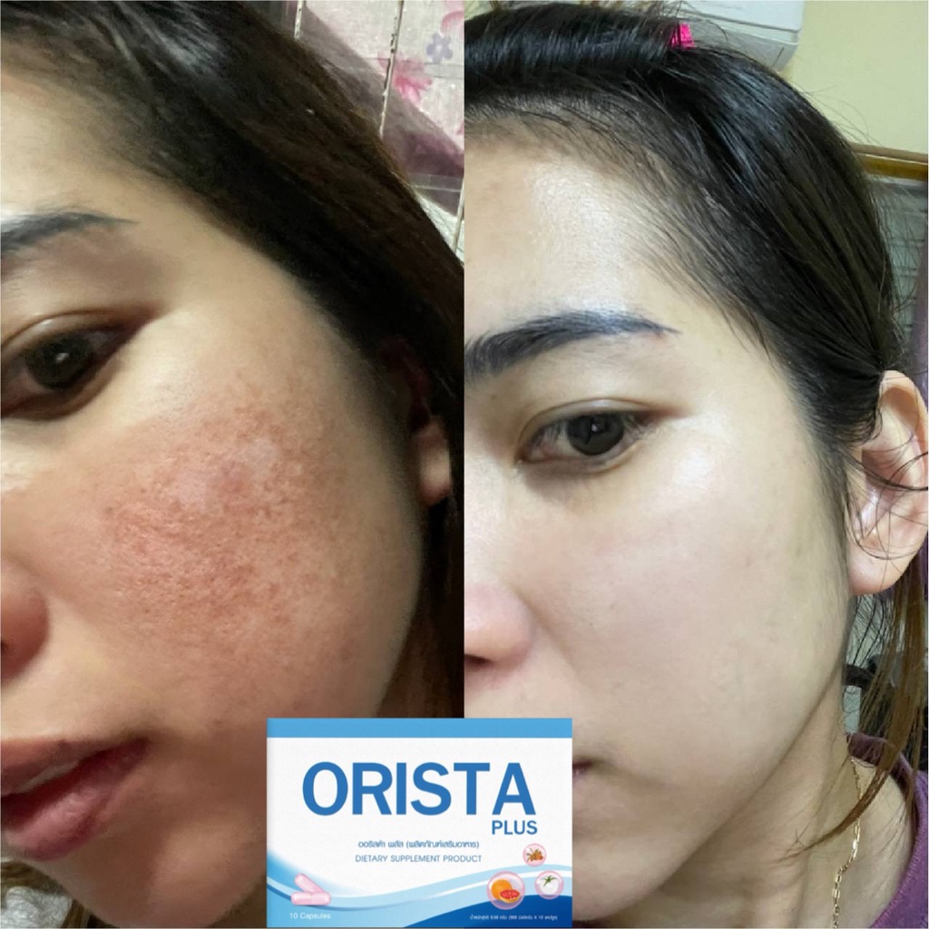 ภาพสินค้าโค้ดลด 200 วิตามิน ORISTA PLUS ออริสต้าพลัส สลายฝ้า กระ จุดด่างดำ ปรับผิวขาวใส จากร้าน panita_1314 บน Shopee ภาพที่ 4