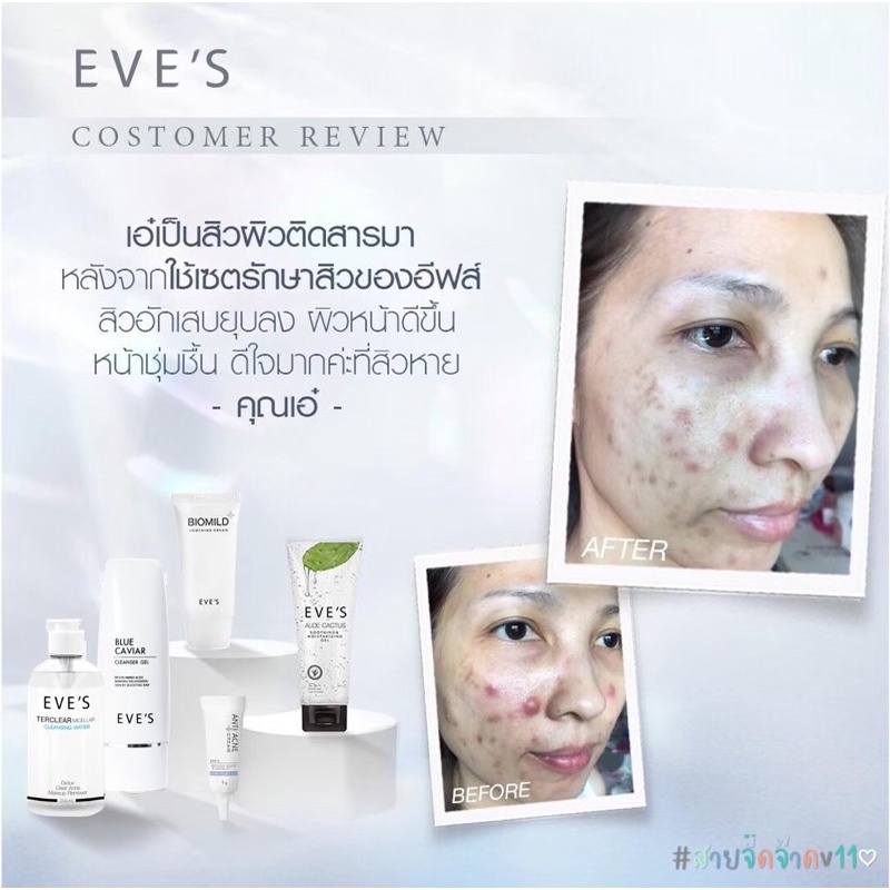 แท้-ส่ง-ไม่ต้องใช้โค๊ด-อีฟส์เซ็ตรักษาสิว-eve-s-set-for-acne-skin-sensitive