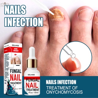 【DREAMER】50ml Toenail Fungus Treatments Anti Fungus Nail Solution Ringworm Clear Healthy Toenail Growth Toe Nail Treatments