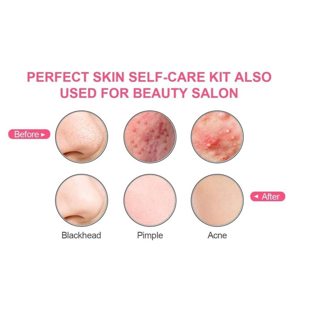 ance-press-kit-ชุดกดสิวดูแลผิวหน้า-ชุดกดสิว-กดสิว-ที่กดสิว-ที่กดสิวหัวดำ-เครื่องกำจัดสิว-เครื่องกำจัดสิวหัวดำ-สำหรับสิว