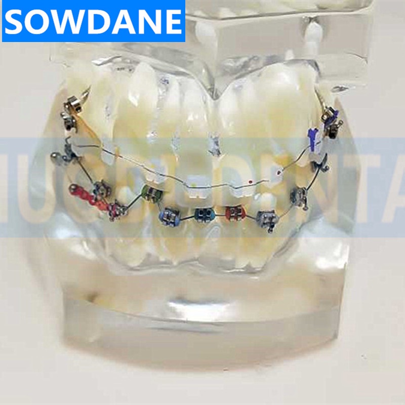 transparent-dental-orthodontic-mallocclusion-model-with-mental-ceramic-brackets-archwire-buccal-tube-for-patient-communi