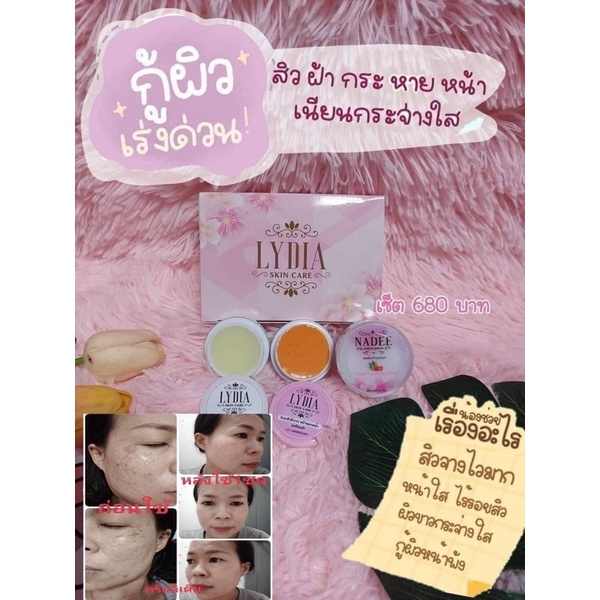 lydia-cream-ครีมลิเดีย-ช่วยเรื่อง-สิว-ฝ้า-กระ-ครีมลิเดีย-lydia-cream-ครีมรักษา-สิว-ฝ้า-กระ-ลดการสร้างเม็ดสี-ทำให้ฝ้า