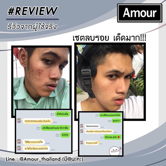 amour-scar-set-เซตลบรอยแผลเป็น