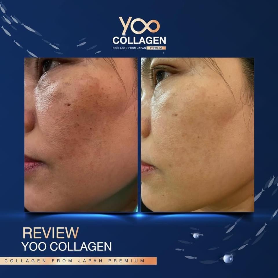 yoo-collagen-ยูคอลลาเจน-คอลลาเจนบริสุทธิ-จากประเทศญี่ปุ่น-กินดีมาก-มีรีวิว-ส่งฟรี-มีสินค้าพร้อมส่งทันที