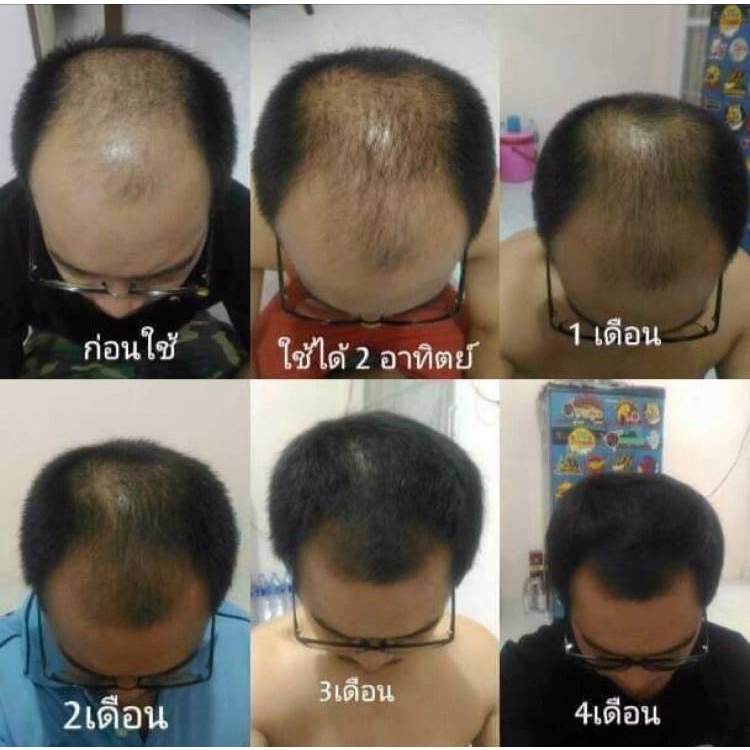 neo-hair-lotion-ของแท้-เซรั่มปลูกผม-นีโอแฮร์โลชั่น-neohair-นีโอแฮร์-ของแท้-ส่งด่วนทุกวัน-จากโรงงาน