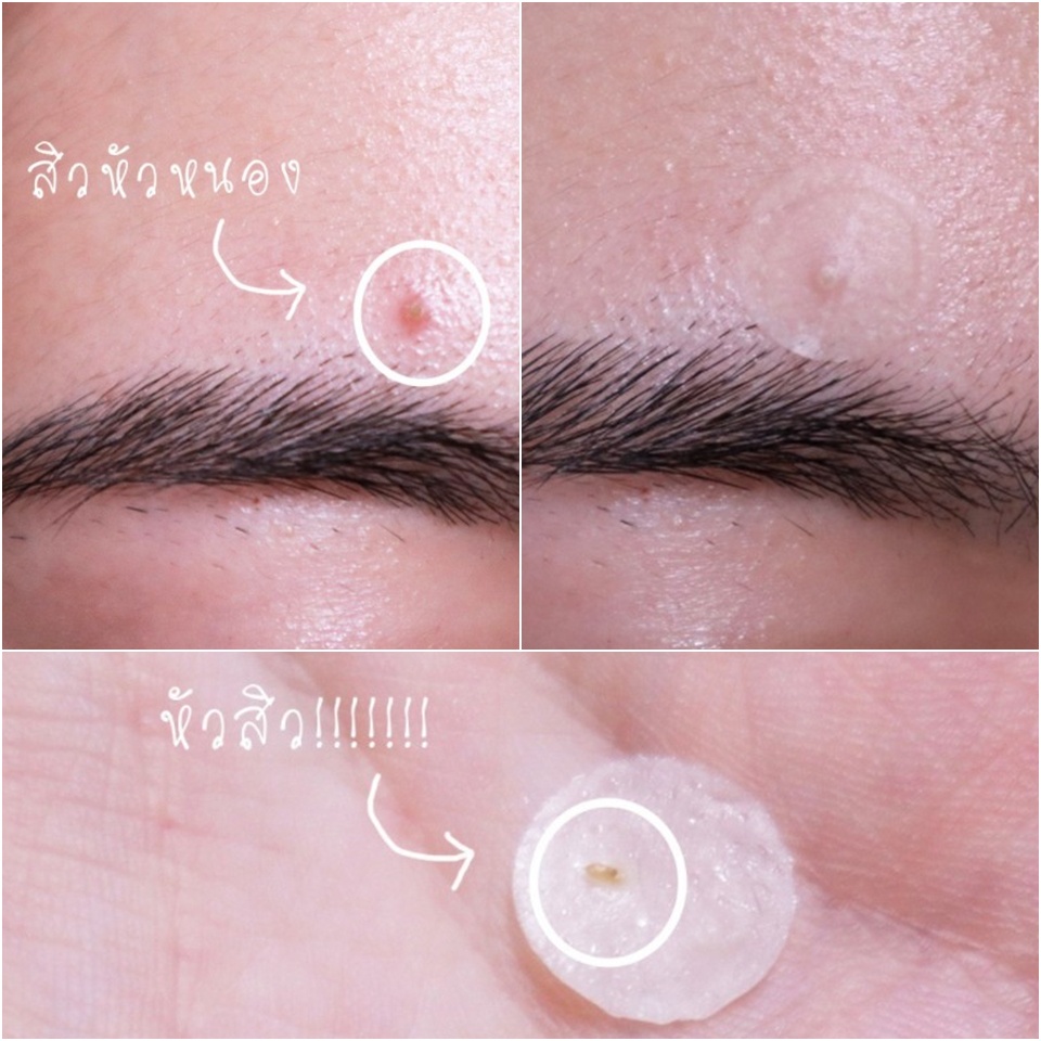 memuzsr-ลดเพิ่มทันที-45-dermaangel-แผ่นแปะสิวเดอร์มาแองเจิล-combo-set-36-ชิ้น-1กล่อง-d12n24