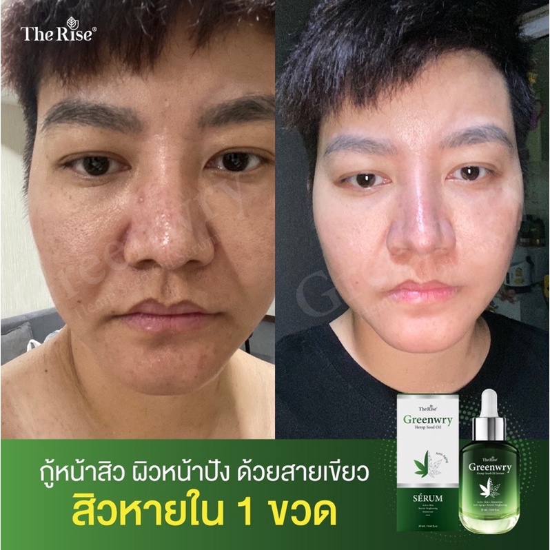 ส่งฟรี-มีของแถม-greenwry-serum-เซรั่มกัญชงลดสิวอักเสบ-ดีท็อกมาร์กหน้าแก้ฝ้ากระ-จุดด่างดำ-ริ้วรอยจางเห็นผลทันที