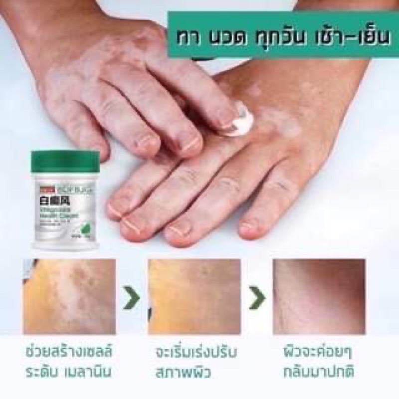 ผิวด่างขาวครีมสมุนไพรจีน-vitiligo-health-cream-ช่วยได้