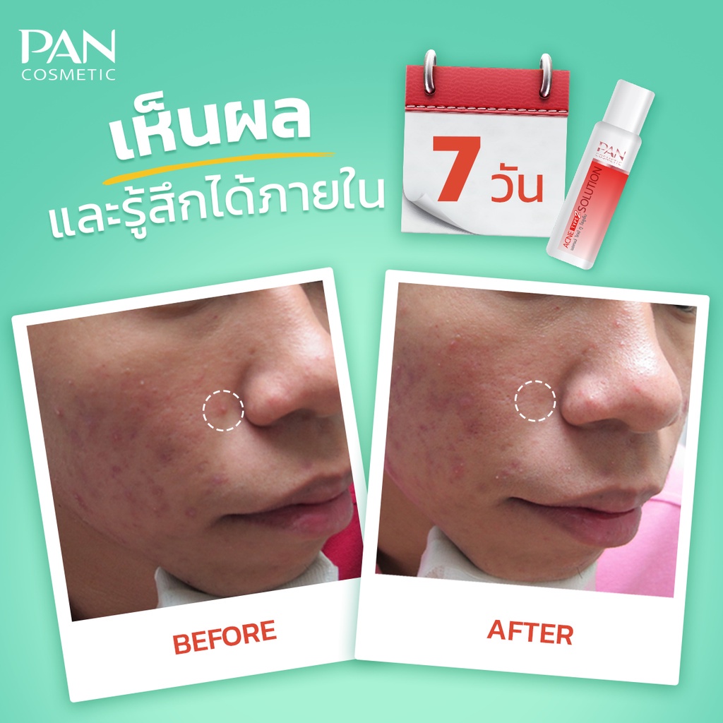 pan-cosmetic-acne-type-1-cream-10g-2-solution-20ml-แพน-คอสเมติก-แอคเน่-ไทป์-วัน-ครีม-10กรัม-ทู-โซลูชัน-20มล