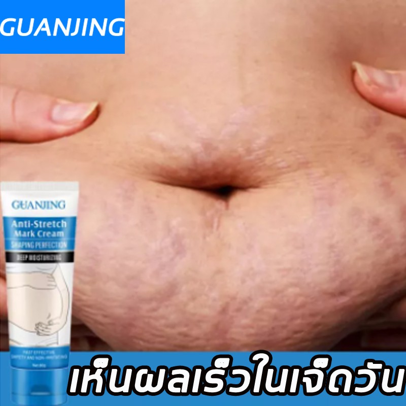 guanjing80g-ยาทารอยแตกลาย-ครีมทาลดรอยแตก-ครีมลดรอยแตกลาย-ครีมแก้แตกลาย-ครีมแก้ท้องลาย-ครีมทาแตกลาย-ครีมกันแตกลาย