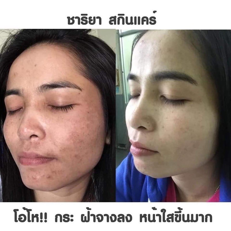 9-9-แถมสบู่-ชุดขายดี-ฝ้า-หน้าใส-1-240-ของแถมมีจำนวนจำกัด