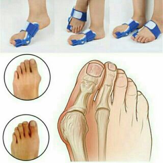 1 คู่/เฝือกเท้าบรรเทาอาการ Hallux Valgus