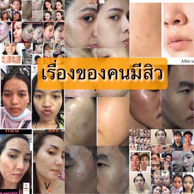 เซรัมวิตตามินซี-เซรั่มรัชชา-ฆ่าเชื้อสิวให้หมด-เร่งหน้าใส-ไร่รอยดำ-หน้าสว่างกระจ่างใสได้จริง