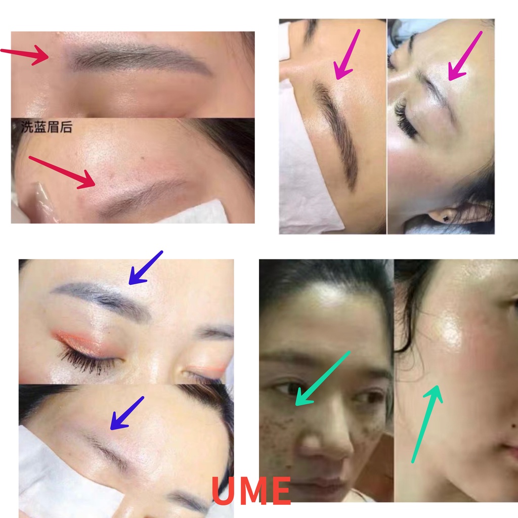 tattoo-removal-eyebrow-pigment-wrinkle-removal-black-doll-carbon-peeling-whitening-blackhead-removal-1064nm-amp-532nm-las