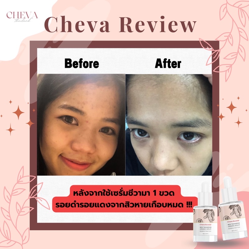 cheva-booster-serum-แบบแพ็คคู่สุดคุ้ม-เซรั่มหน้าใส-ป้องกันการเกิดสิว-ลดรอยสิว-กู้ผิวเด็ก-ด้วยสารสกัดจากธรรมชาติ-100