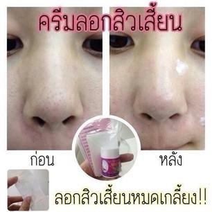 ครีมลอกสิวเสี้ยน-สูตรเวียดนาม-ขั้นเทพ-ฃายดีมากๆ