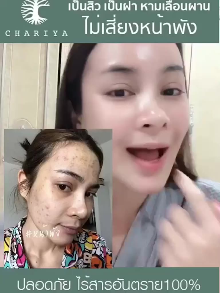 ส่งฟรี-เซตมินิ-เร่งสลายฝ้าไว-x2-พร้อมป้องกันการเกิดฝ้าใหม่-ลดสิว-ครีมชาริยา-ครีมหน้าสวย-สบู่ใบบัวบก-เซรั่มแพลงก์ตอน