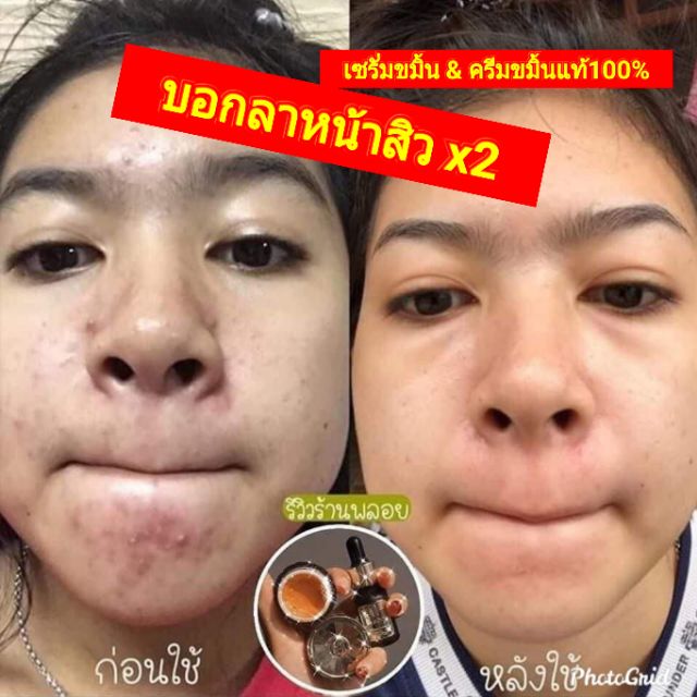 บอกลาหน้าสิว-herbal-ครีมขมิ้นแท้100-มี-อย-ไร้สาร