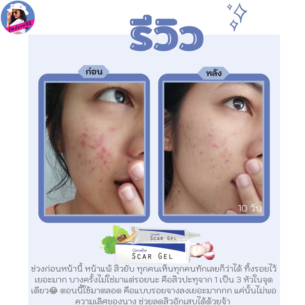 สกาเจล-กิฟฟารีน-สการ์เจล-scargel-giffarine-รอยสิว-รักษาสิว-ครีมแต้มสิวอักเสบ-รอยแผล-รอยแดง-รอยดำ-แผลผ่าตัด