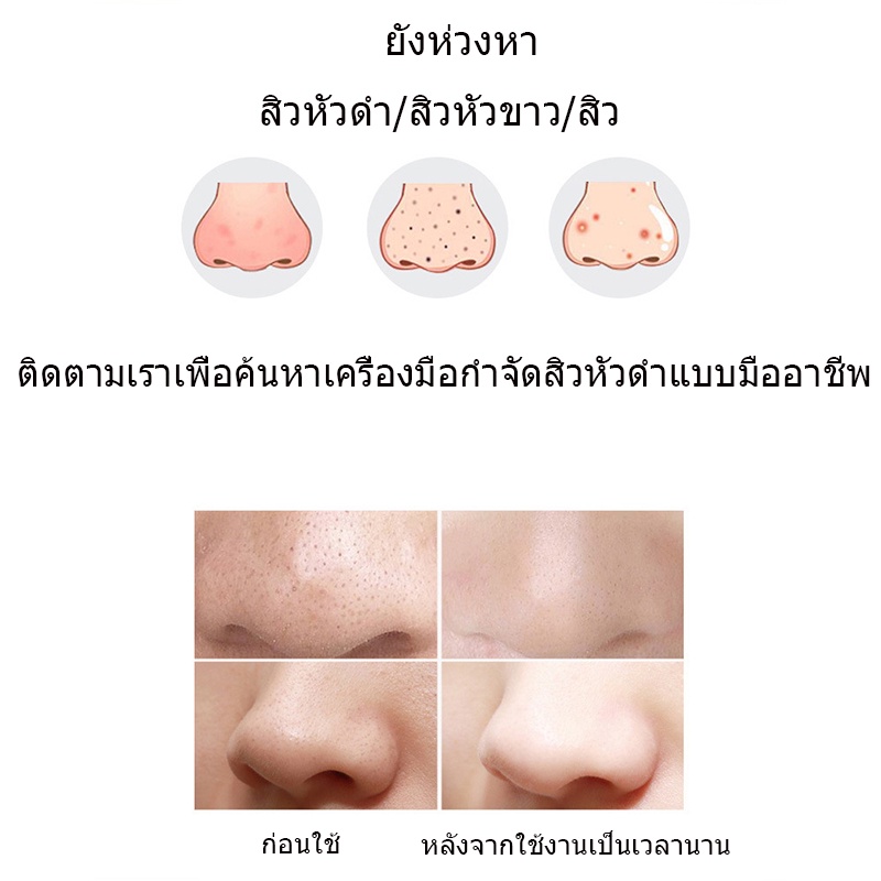 เครื่องดูดสิว-ที่ดูดสิวเสี้ยน-สิวข้างจมูก-ดูดสิวเสี้ยนอุดตันลบรอยจุดดำจากสิวเสี้ยนที่จมูก-เครื่องดูดสิวไฟฟ้า