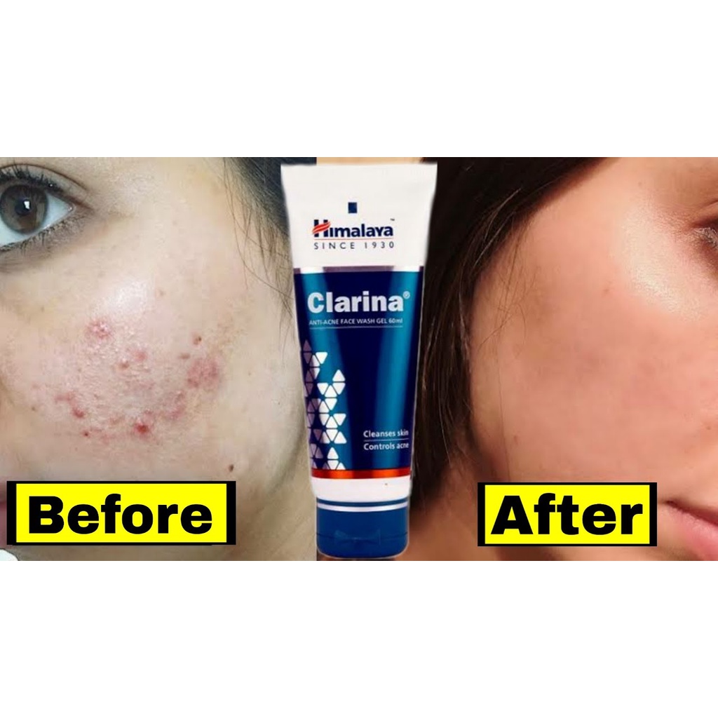 Gel Nettoyant Visage Himalaya Clarina - Anti-acné - 60 Ml - Neuf