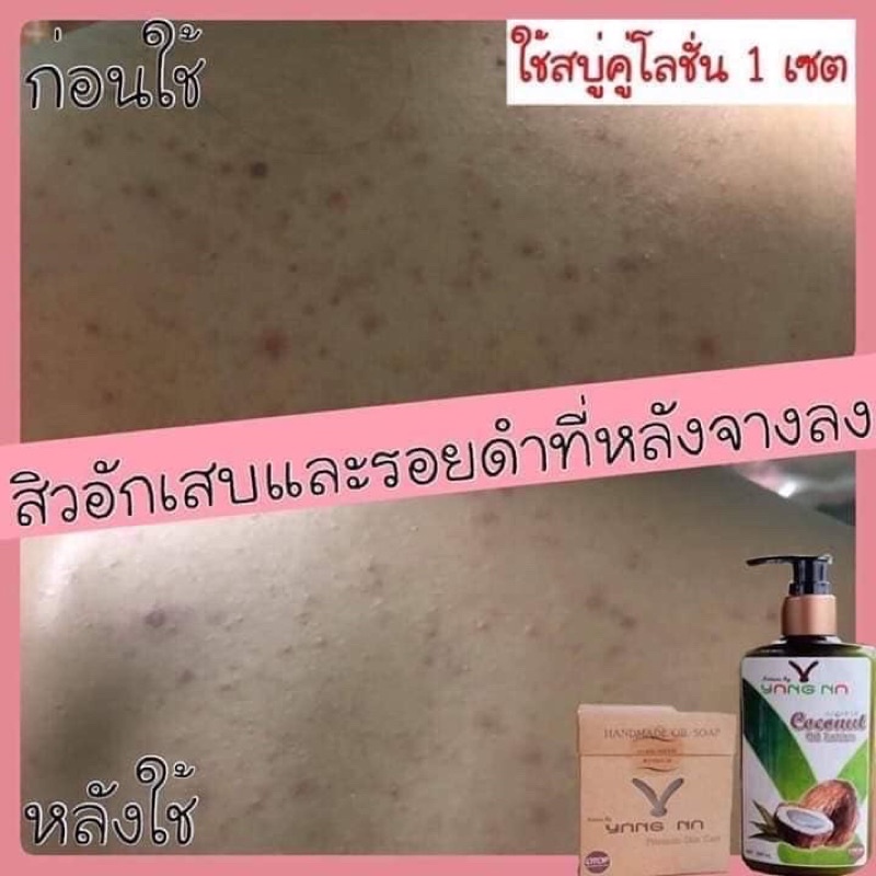 สบู่ลดสิว-สบู่น้ำมันธรรมชาติ-สบู่แก้ผดผื่น-สบู่รักษาสิวตามร่างกาย-สบู่รักษาสิวที่หลัง-สบู่บำรุงผิว