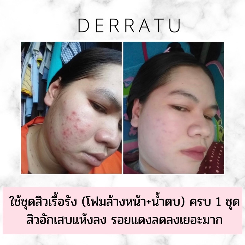 โฟมล้างหน้า-derratu-90g-2-ชิ้น-ลดสิวอุดตัน-ลดสิวหน้าใส-ลดมัน-ลดแผลสิว-หลุมสิวตื้น-รูขุมขนกระชับ