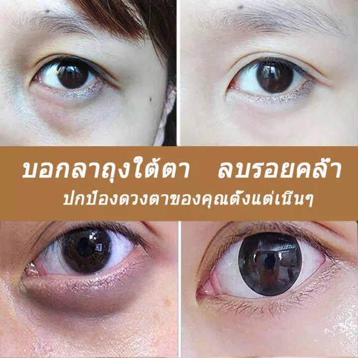ครีมบำรุงรอบดวงตา-ครีมบำรุงใต้ตา-ครีมลดถุงใต้ตา-ครีมทาใต้ตาดำ-อายครีม-ปรับปรุงตาดำถุงใต้ตาและปัญหารอบดวงตาอื่น-ต่อต้านริ