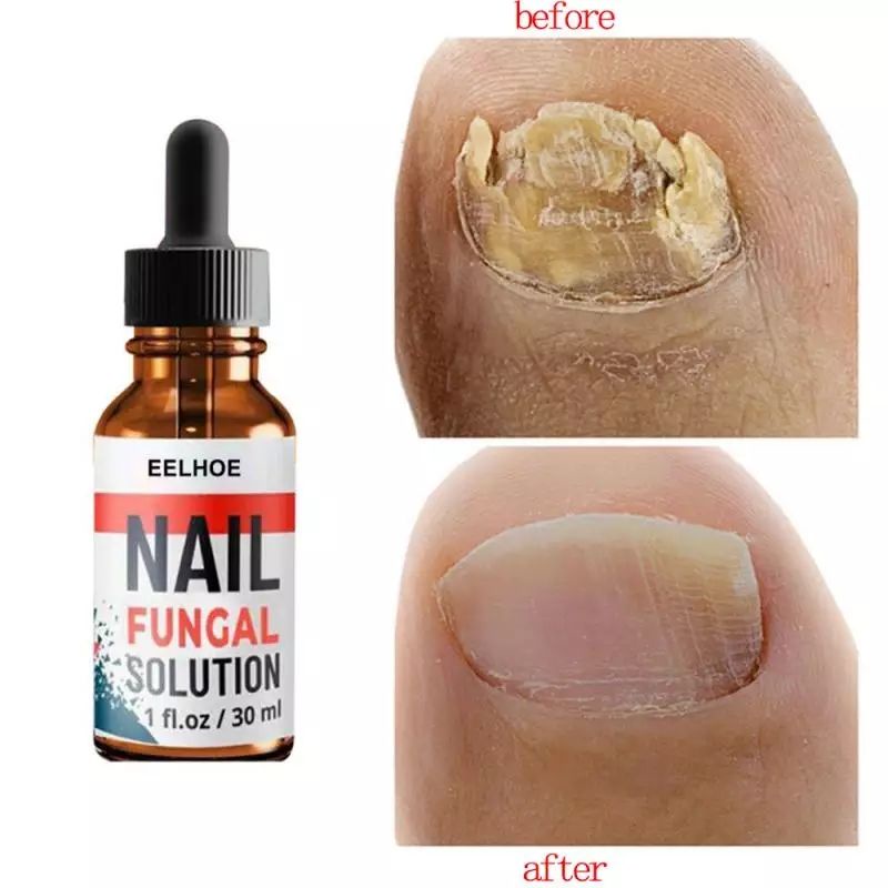 nall-fungal-วิธีแก้ปัญหาการรักษาเชื้อราเล็บ-มือและเล็บเท้าที่แข็งแรงติดเชื้อรา