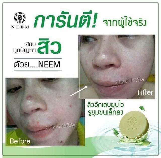 neem-bright-amp-clear-acne-soap-50g-สบู่นีม-สบู่สิวหลุด-บอกลาหน้าสิว-สู่หน้าใส